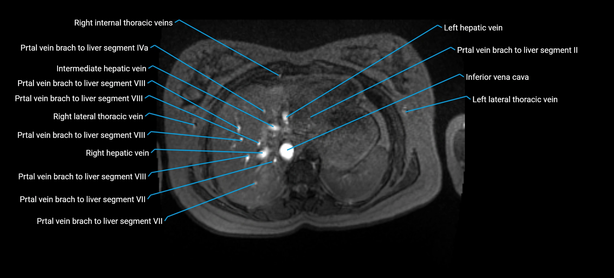 MRV abdomen pelvis & lower limb axial cross sectional anatomy labelled MRI image 25 (2).webp